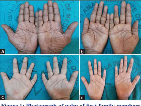 [PDF] The enigma of the simian crease: case series with the literature review | Semantic Scholar