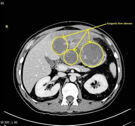 Pyogenic liver abscess CT - wikidoc