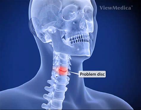 Anterior Cervical Discectomy And Fusion - Austin NeuroSpine