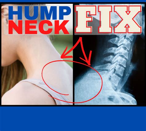 Neck Hump Fix - Chiropractic on Eagle, Dr. Jon Saunders