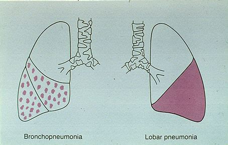 Bacterial Pneumonia