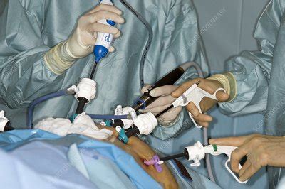 Laparoscopic prostate surgery - Stock Image - C004/5131 - Science Photo Library