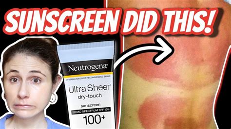 SUNSCREEN allergic reactions and rashes| Dr Dray | Dr dray, Sunscreen, Dermatologist doctor