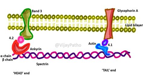 Pathology of Hereditary Spherocytosis - Pathology Made Simple