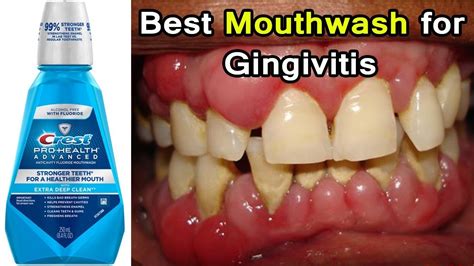 Top 3 Best Mouthwashes for Gingivitis Disease | Periodontal Disease - YouTube