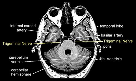 Gamma Knife for Trigeminal Neuralgia