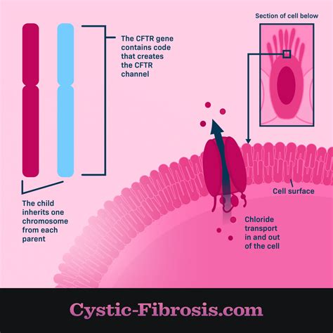 How Does Cystic Fibrosis Develop? | Cystic-Fibrosis.com