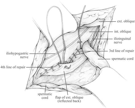 Figure 11 from The Shouldice repair for groin hernias. | Semantic Scholar