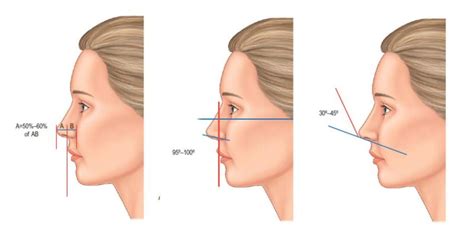 What are the criteria for a perfect nose shape?Can I get it?