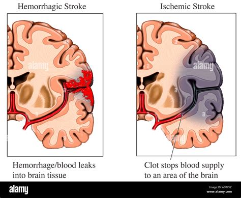 Stroke Risk Factors