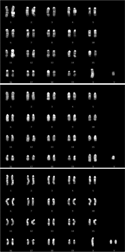 Transmission of Y chromosomes from XY female mice was made possible by the replacement of ...