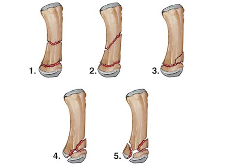 Thumb fracture