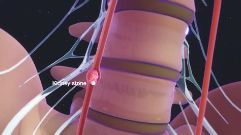 Flank Pain - Kidney and Urinary Tract Disorders - MSD Manual Consumer ...