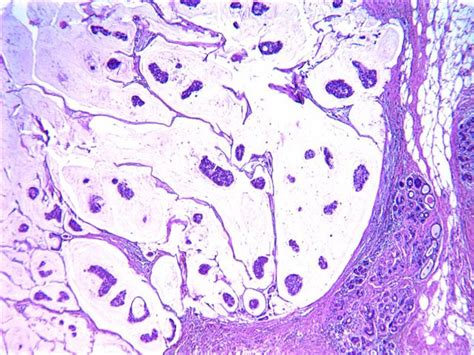 mucinous carcinoma breast histology