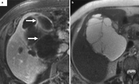 The Biliary Tree | Radiology Key