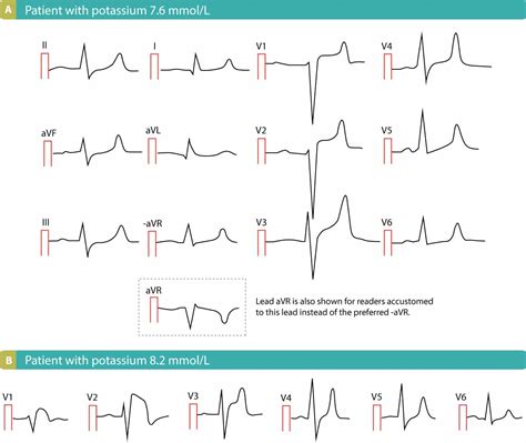 ECG changes due to electrolyte imbalance (electrolyte disorder) – ECG ...