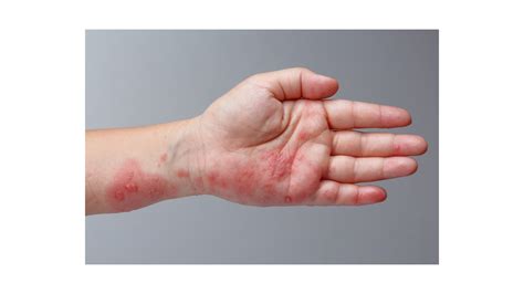 Ivermectin for Scabies- and More - JASE Medical