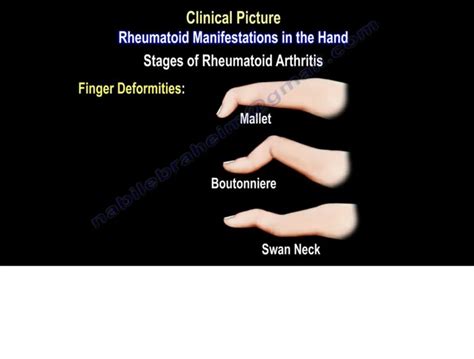 Rheumatoid Arthritis Of The Hand — OrthopaedicPrinciples.com