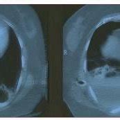 The chest CT scan showing the right haemithorax, the lung lacerations... | Download Scientific ...