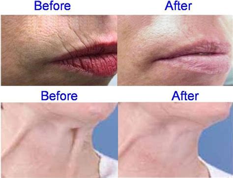 Advanced Medical Aesthetics - Rome, Italy - Botox Before & After Pictures 3