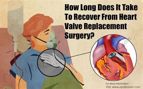 How Long Does It Take To Recover From Heart Valve Replacement Surgery ...