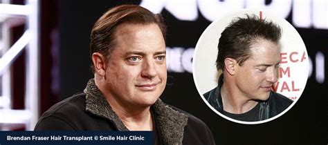 Brendan Fraser Hair Transplant - Smile Hair Clinic