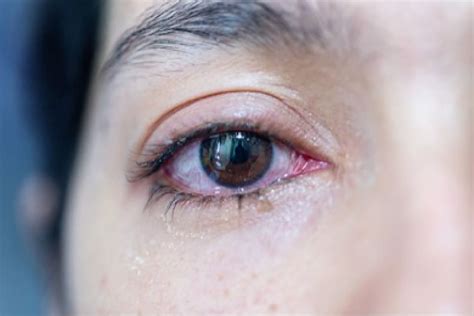 Meibomian Gland Dysfunction: Signs, Causes & Treatment | MyVision.org