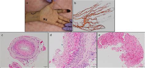 Figure1.Imaging and histological findings of necrosis in the second... | Download Scientific Diagram