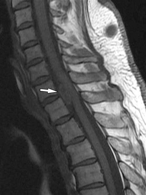 Intradural Extramedullary Spinal Neoplasms: Radiologic-Pathologic Correlation | RadioGraphics