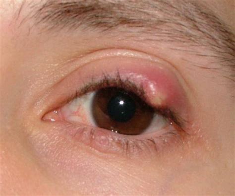 Chalazion (Eyelid Cyst) Causes, Symptoms, Treatment | Healthhype.com