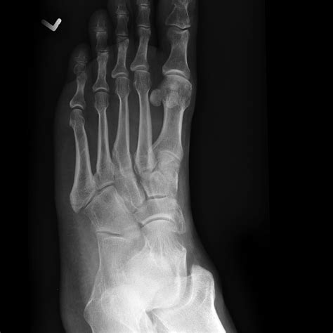 Pseudo Jones Fracture