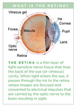 Lattice Degeneration - San Diego Retina Associates