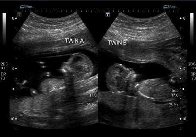 Fraternal Twins - 13 Weeks Ultrasound