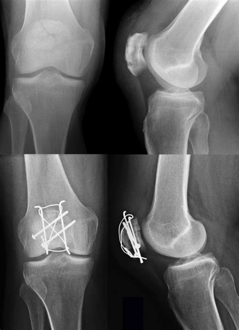 Preoperative X-rays of a comminuted patella fracture (above). 3 months... | Download Scientific ...