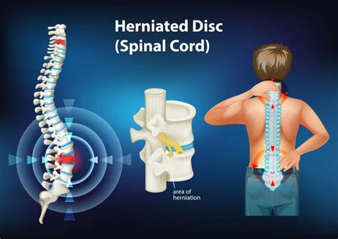 Prolapsed Disc Treatment Singapore | Disc Replacement Surgery