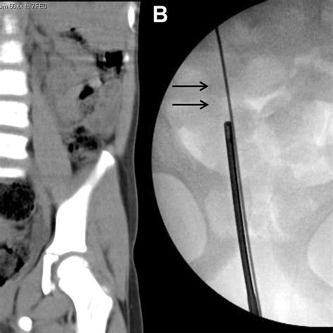 Patient is placed in dorsal lithotomy position with the surgeon ...