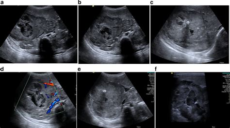 -Total abdominal ultrasound shows: (A) and (B) hepatomegaly secondary... | Download Scientific ...