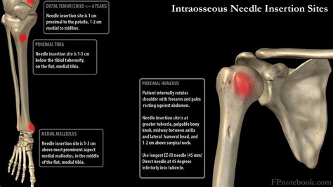 Intraosseous Access