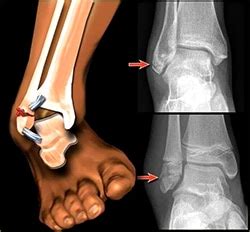 Ankle Fracture Repair Treatment & Surgery | Spine & Orthopedic Center