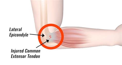 Tennis Elbow - Symptoms, Causes, Treatment & Exercises