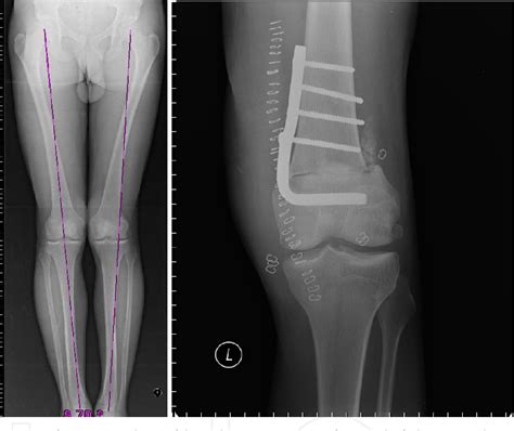 Figure 1 from High Tibial Osteotomy | Semantic Scholar