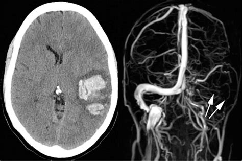 Cerebral venous thrombosis causes, risk factors, symptoms, diagnosis, treatment & prognosis