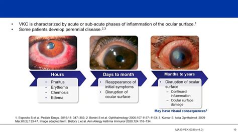 Understanding Vernal Keratoconjunctivitis (VKC): Not “Just an Allergy” - YouTube