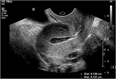 Sonohysterographic measurement of endometrial thickness