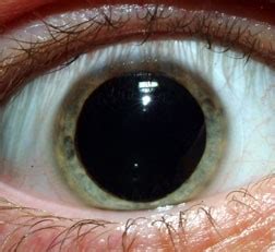 Dilating Eye Drops - American Association for Pediatric Ophthalmology ...