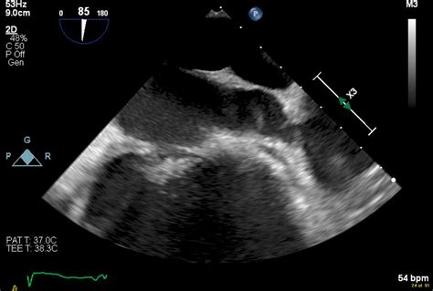 Left Atrial Appendage Thrombus - Clinical Tree