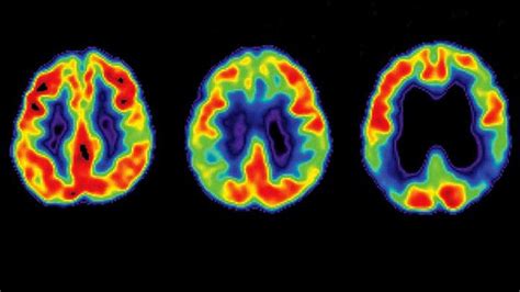 Alzheimer’s disease progresses through three main stages: mild (early-stage), moderate (middle ...