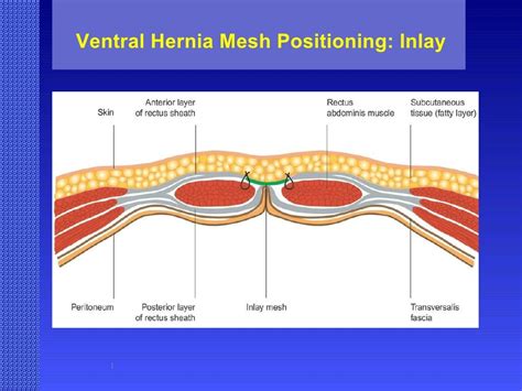 Hernia Prophylactic Mesh Placement To Avoid Incisiona - vrogue.co