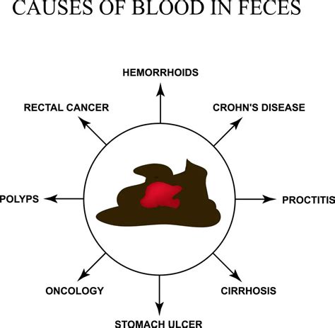 Causes Of Blood In Stool | STD.GOV Blog