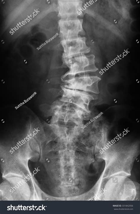 X-Ray Image Of Lumbosacral Spine Showing Osteoarthritis Of Lumbar ...